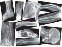 Röntgenbilder Knochenbrüche Röntgenbilder Knochenbrüche