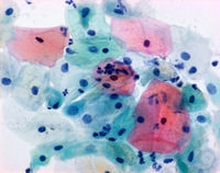 Papanicolaous Lösung 1a Harris'   Hämatoxylinlösung für die   zytologische...