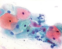 Papanicolaous Lösung 2b Orange IILösung für die zytologische Krebs-und...